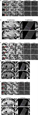 Memory Performance Correlates of Hippocampal Subfield Volume in Mild Cognitive Impairment Subtype